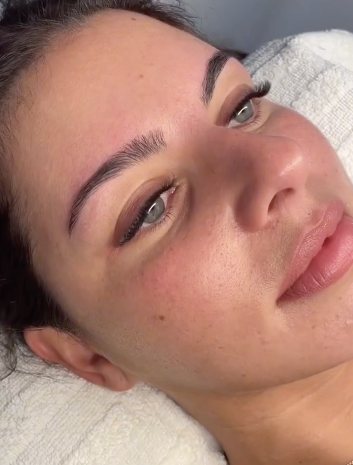 Microneedling & Glow
